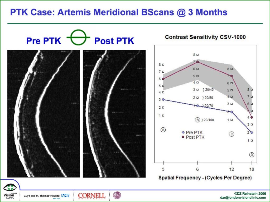 Artemis meridional BScans