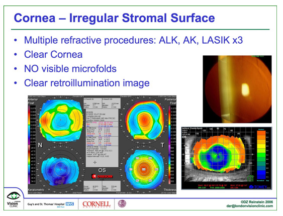 Irregular Stromal Surface