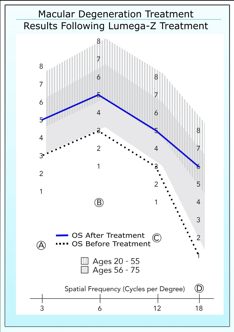 Left Eye of 70 YO White Female Before and 6 months after Treatment with Lumega-Z