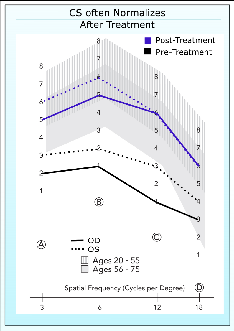 Contrast sensitivity of a glaucoma patient before and after initiation of ocular hypotensive therapy